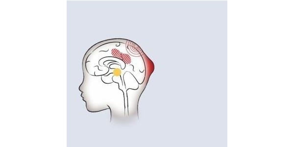 如何用纱布绷带处理头皮血肿