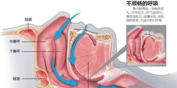 家用呼吸机是如何治疗打鼾