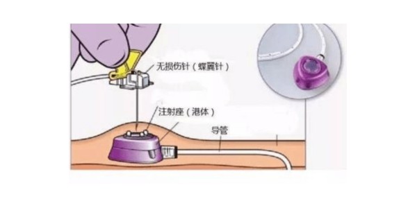 什么是植入式静脉输液港