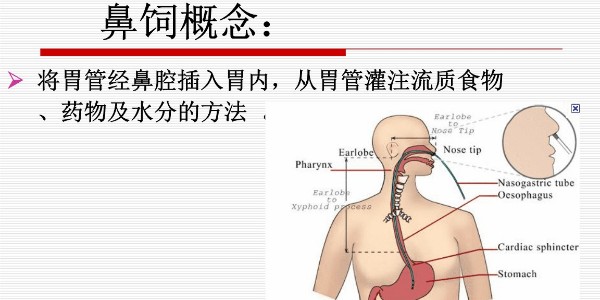 如何给昏迷患者使用注射器鼻饲