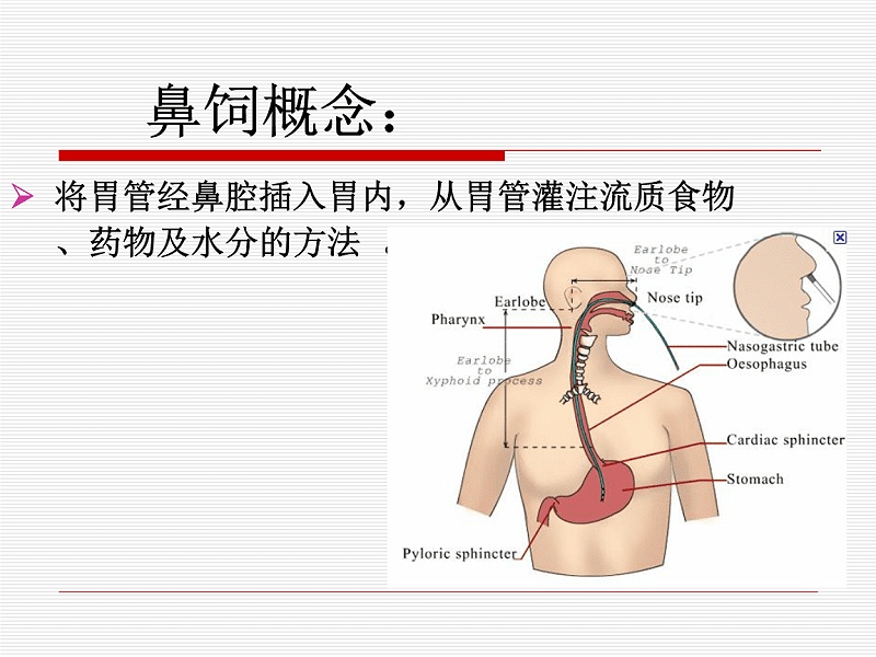 如何给昏迷患者使用注射器鼻饲