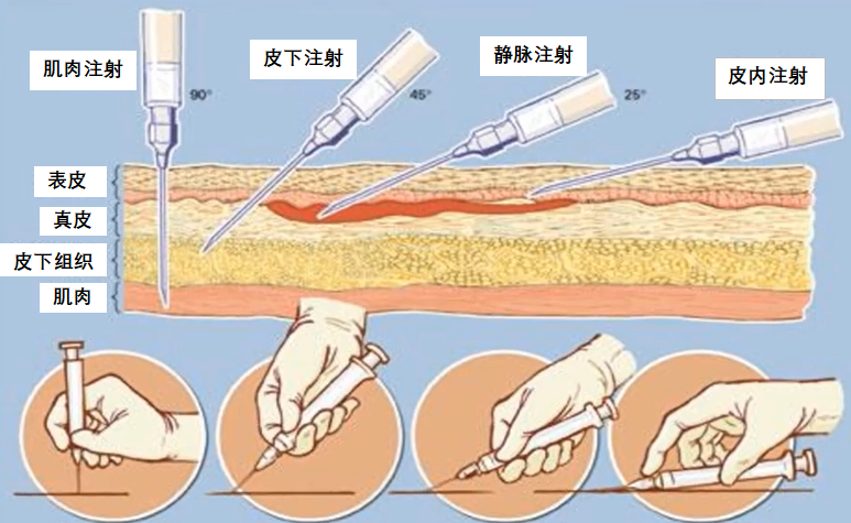 用注射器打针时伤神经怎么办