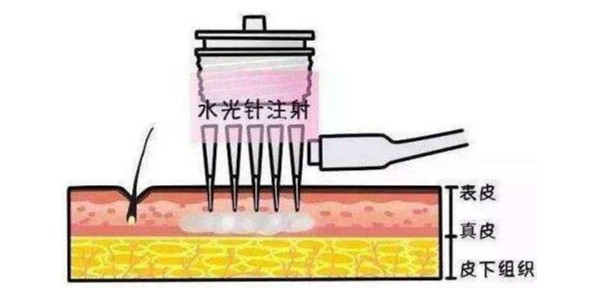 自己打水光针会导致面瘫吗